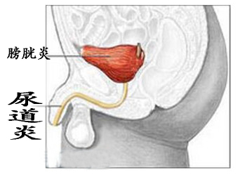 尿道炎給男性患者帶來(lái)哪些危害